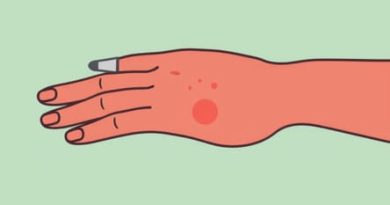 Pimply Rash On Palm Of Hand