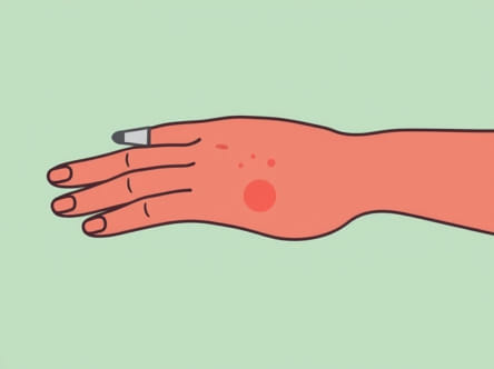 Pimply Rash On Palm Of Hand