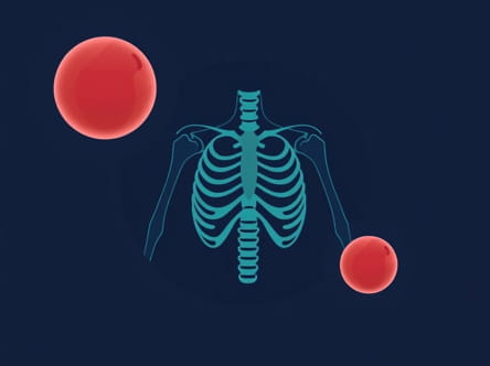 Sarcomas Metastasize Primarily Through The Blood