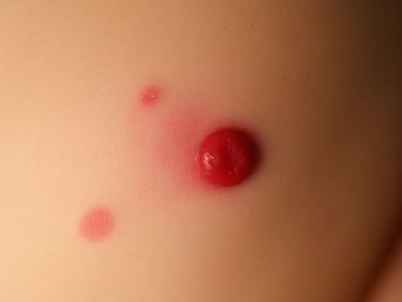 Transient Neonatal Pustular Melanosis Vs Erythema Toxicum