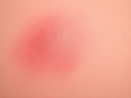 Erythema Toxicum Vs Pustular Melanosis