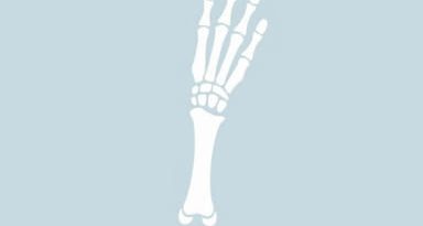 Is Methotrexate For Rheumatoid Arthritis?