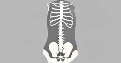 Female Abnormal Lumbar Mri