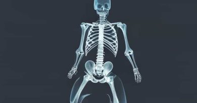 Hodgkin Lymphoma X Ray