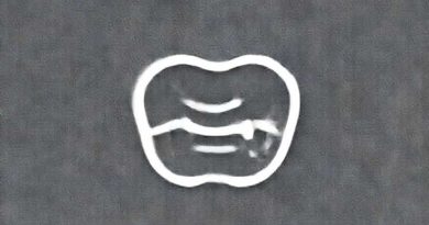 Oral Manifestation Of Diabetes