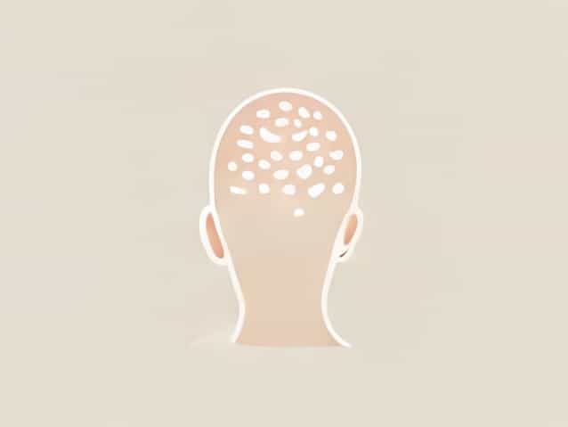 Scalp Eczema Treatment At Home