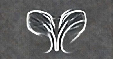 What Causes Pituitary Apoplexy