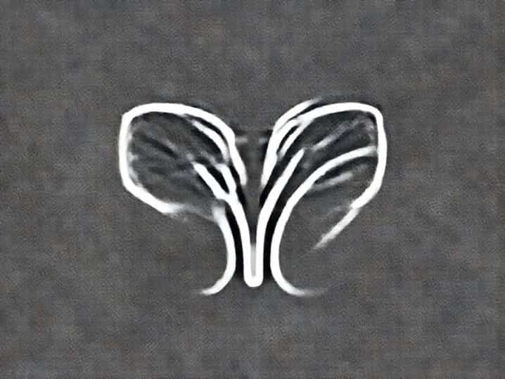 What Causes Pituitary Apoplexy