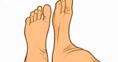 Hallux Rigidus Nonoperative Treatment And Orthotics