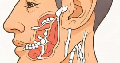 Incomplete Obliteration Of Pharyngeal Groove