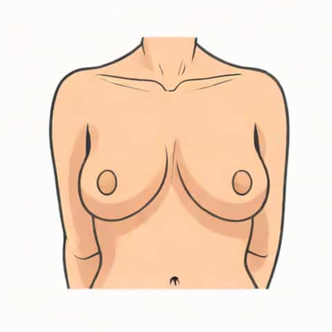 Problems With Breast Implants After Mastectomy