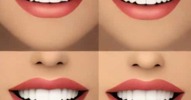 Jaw Filler Before And After